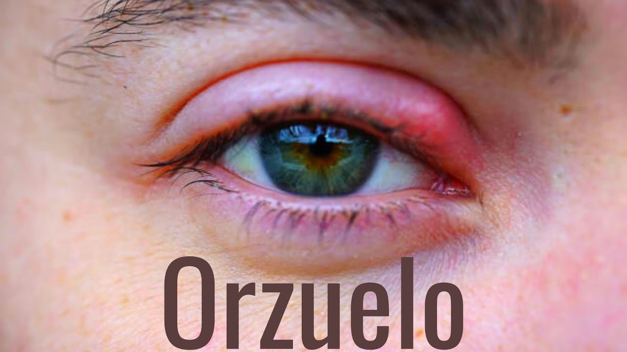 que remedio es bueno para los orzuelos en el ojo