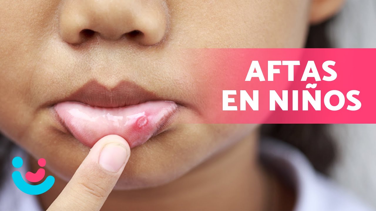 como quitar las aftas de la boca en niños